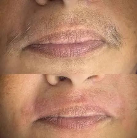 Depilação facial  - Foto 2