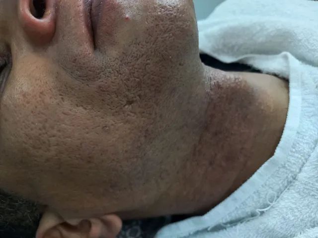Depilação e Epilaçâo + Spa Terapia , terapia das pedras  - Foto 2