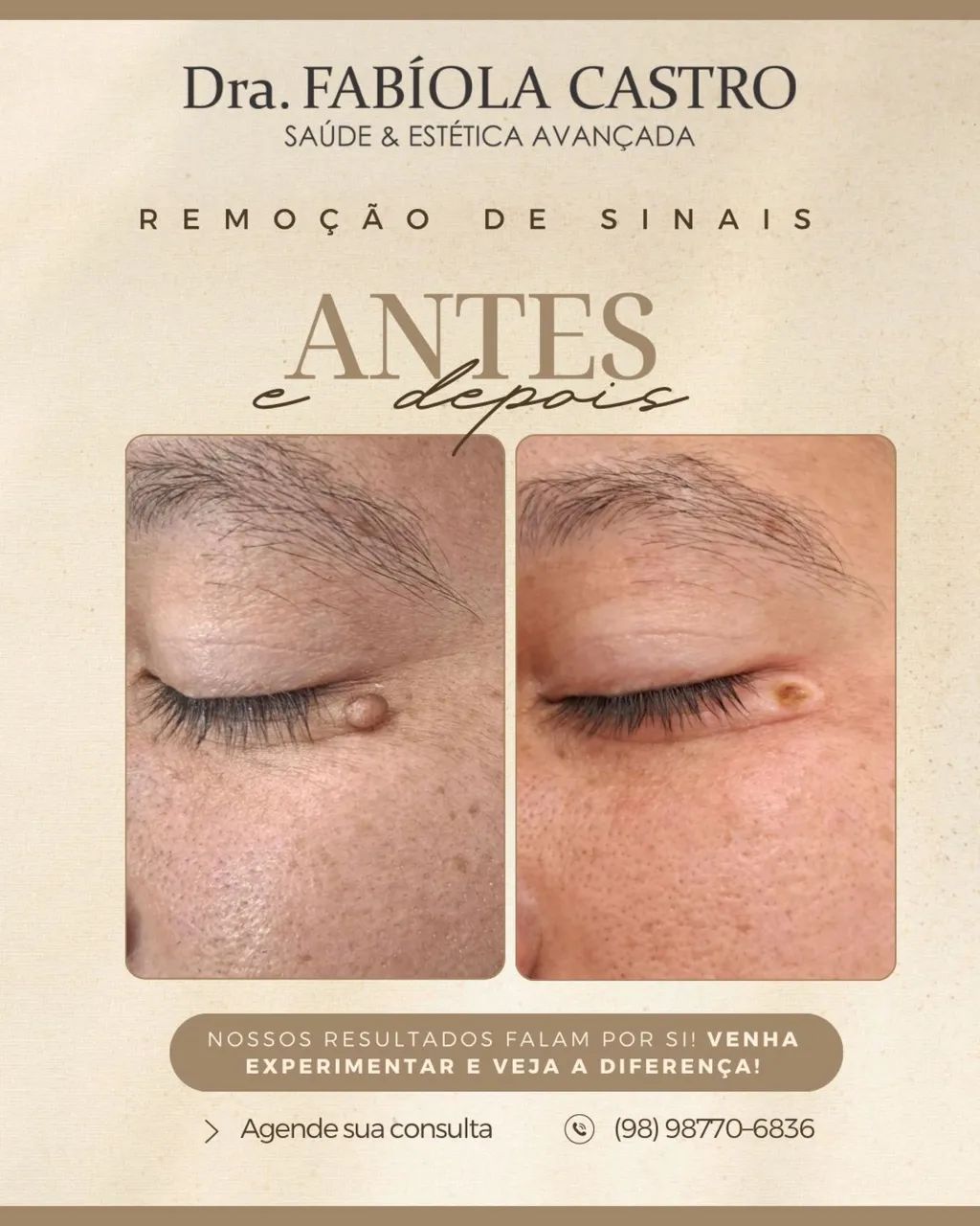 Remoção de sinais | São Luís  - Foto 5