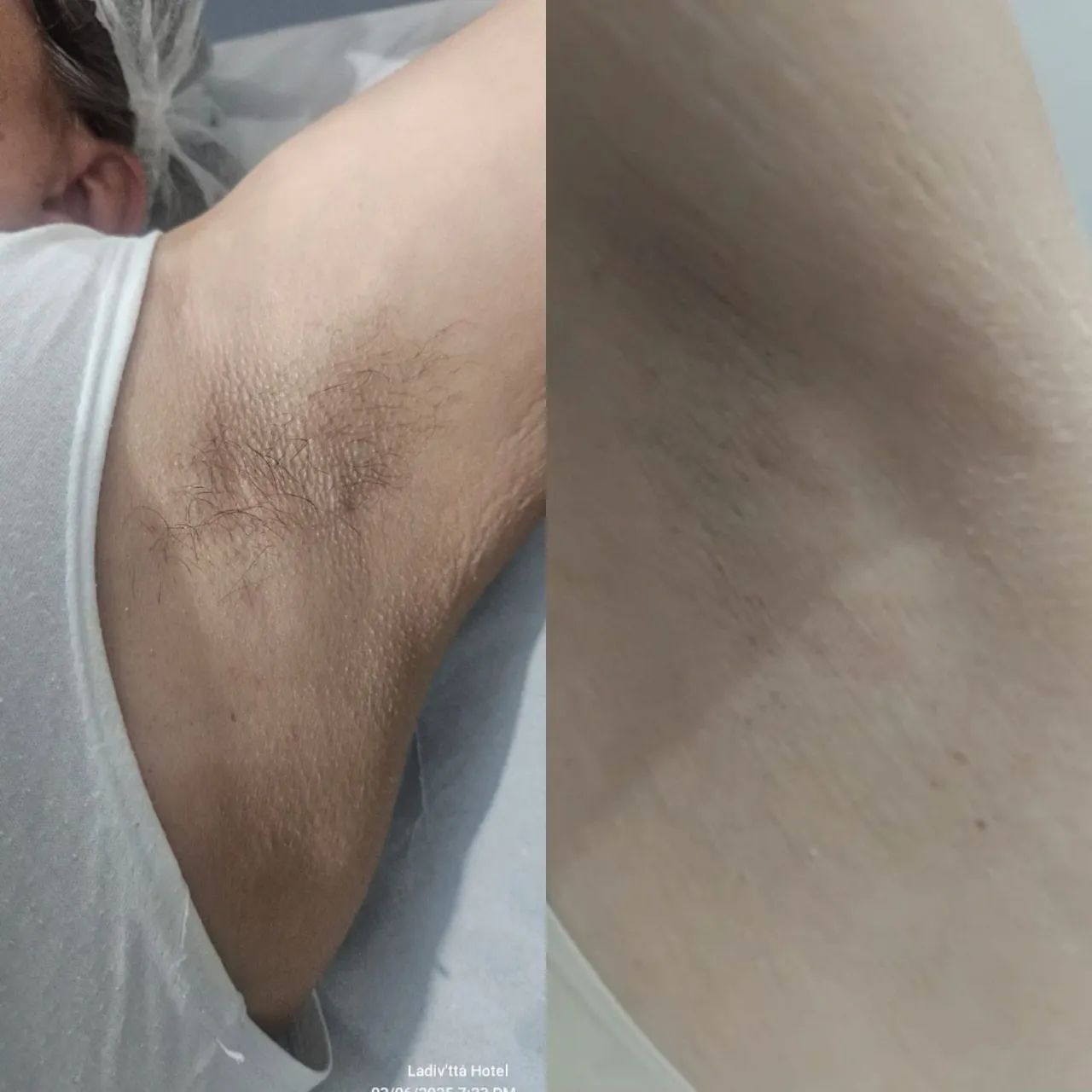 Limpeza de Pele e Depilação a domicílio  - Foto 3