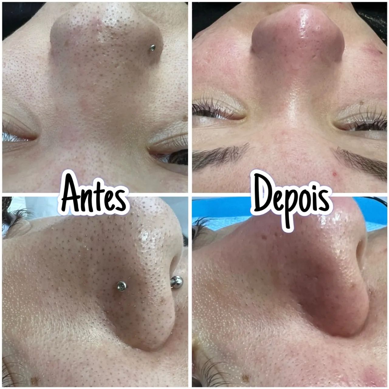 Limpeza de pele promocional - Foto 2