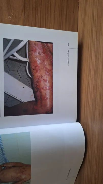 Livro FERIDAS Fundamentos e atualizações em enfermagem. - Foto 6