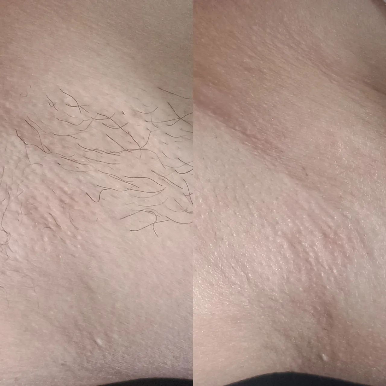Limpeza de Pele e Depilação a domicílio  - Foto 4