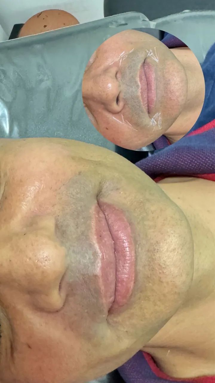 Preenchimento com ácido hialurônico RENNOVA  - Foto 3