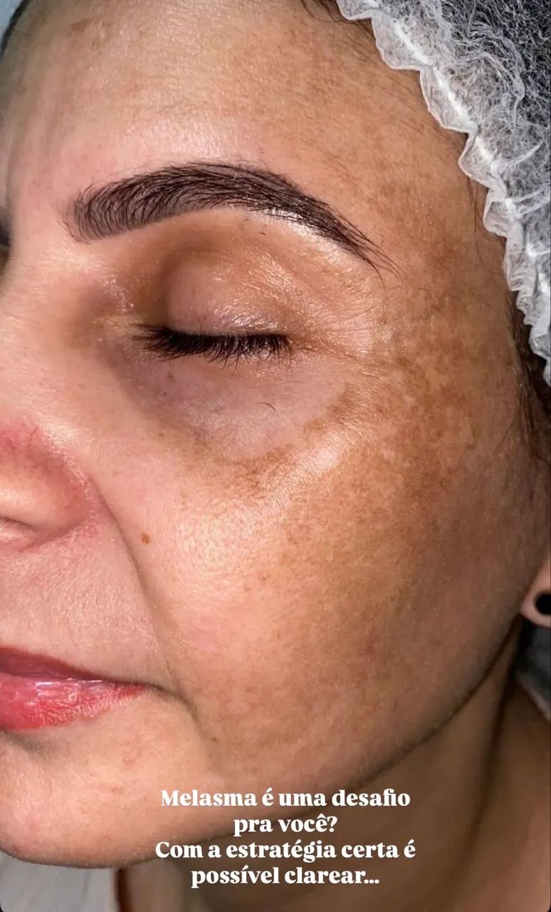 Tratamento para melasma completo e personalizado  - Foto 5