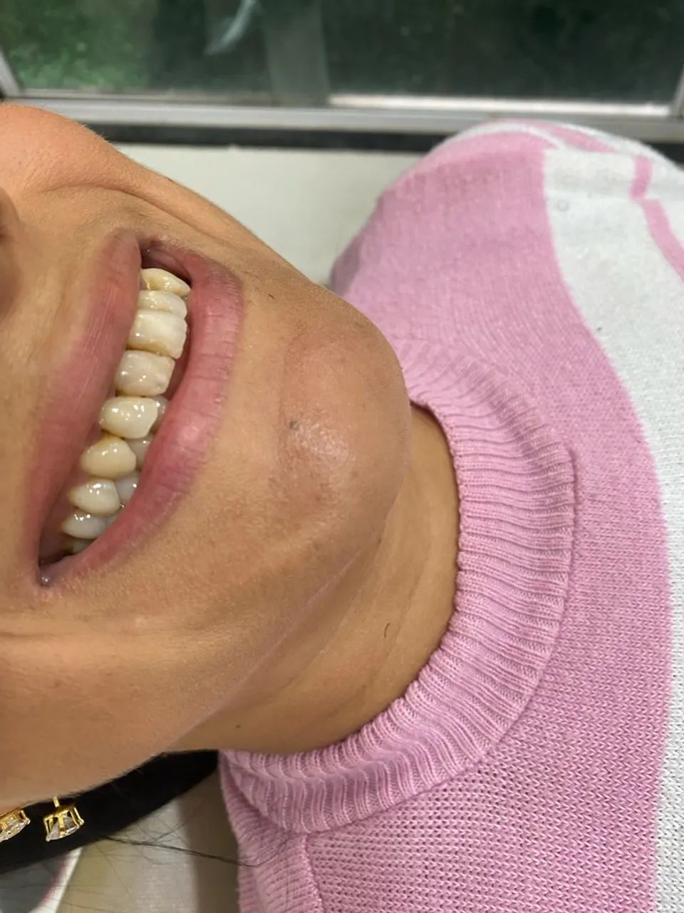Facetas em resina  - Foto 2