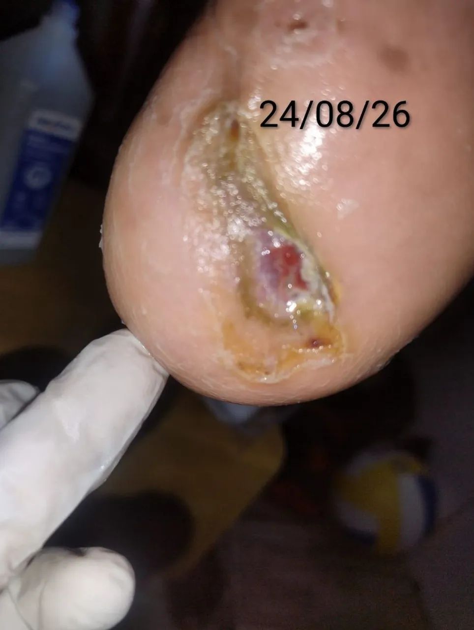 Realização de curativos complexos! - Foto 2