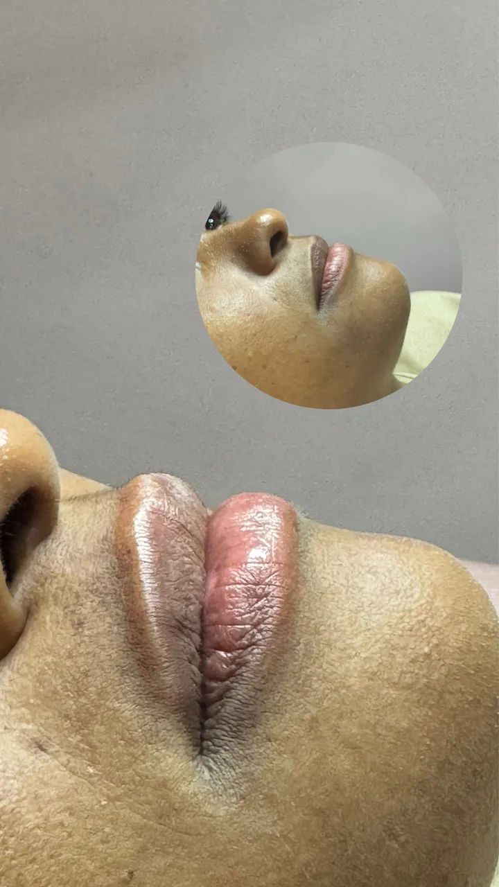 Preenchimento com ácido hialurônico RENNOVA  - Foto 4