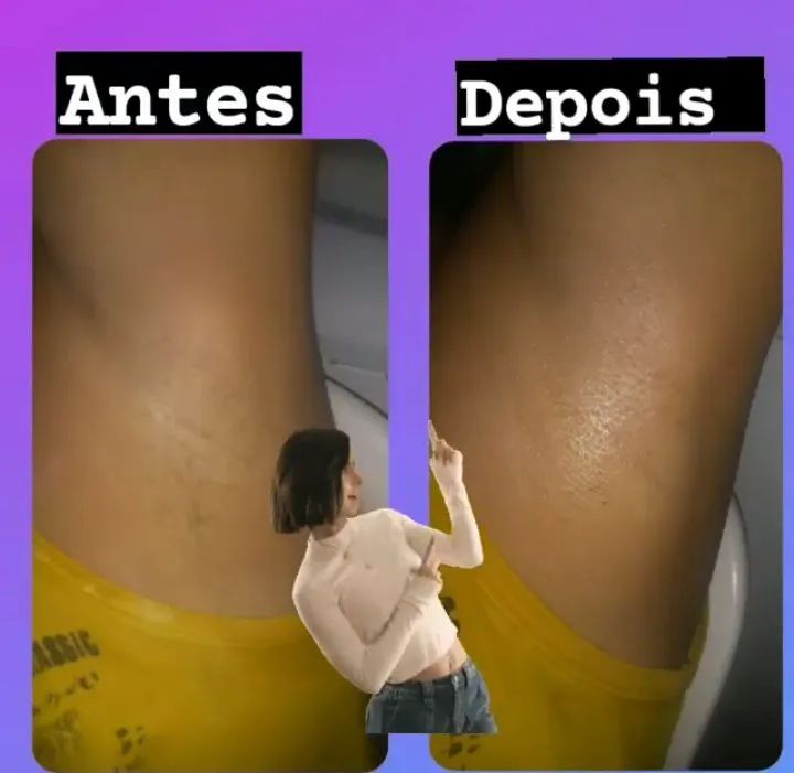 Depilação  - Foto 3