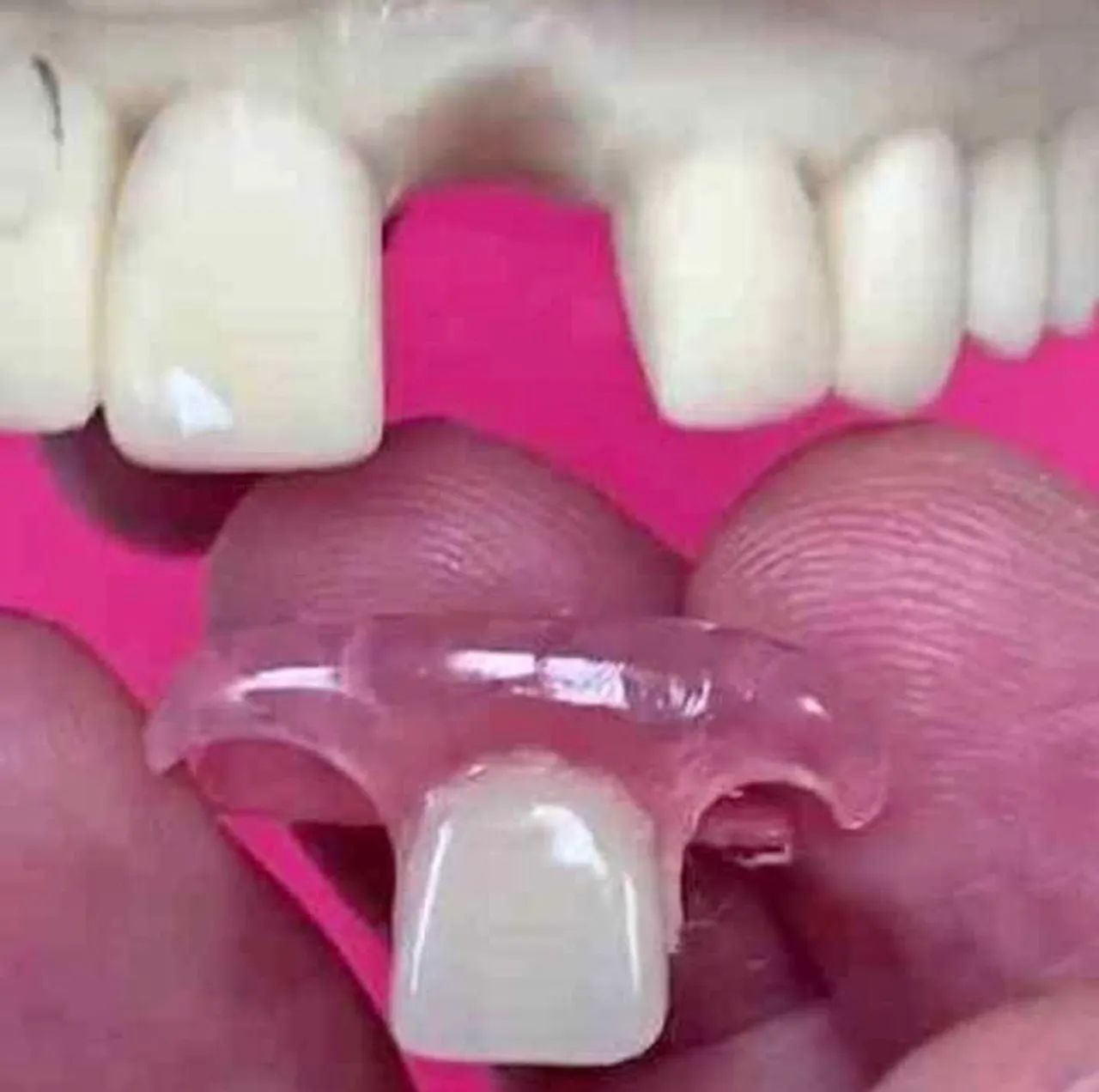 Prótese dentária flexível - Foto 3