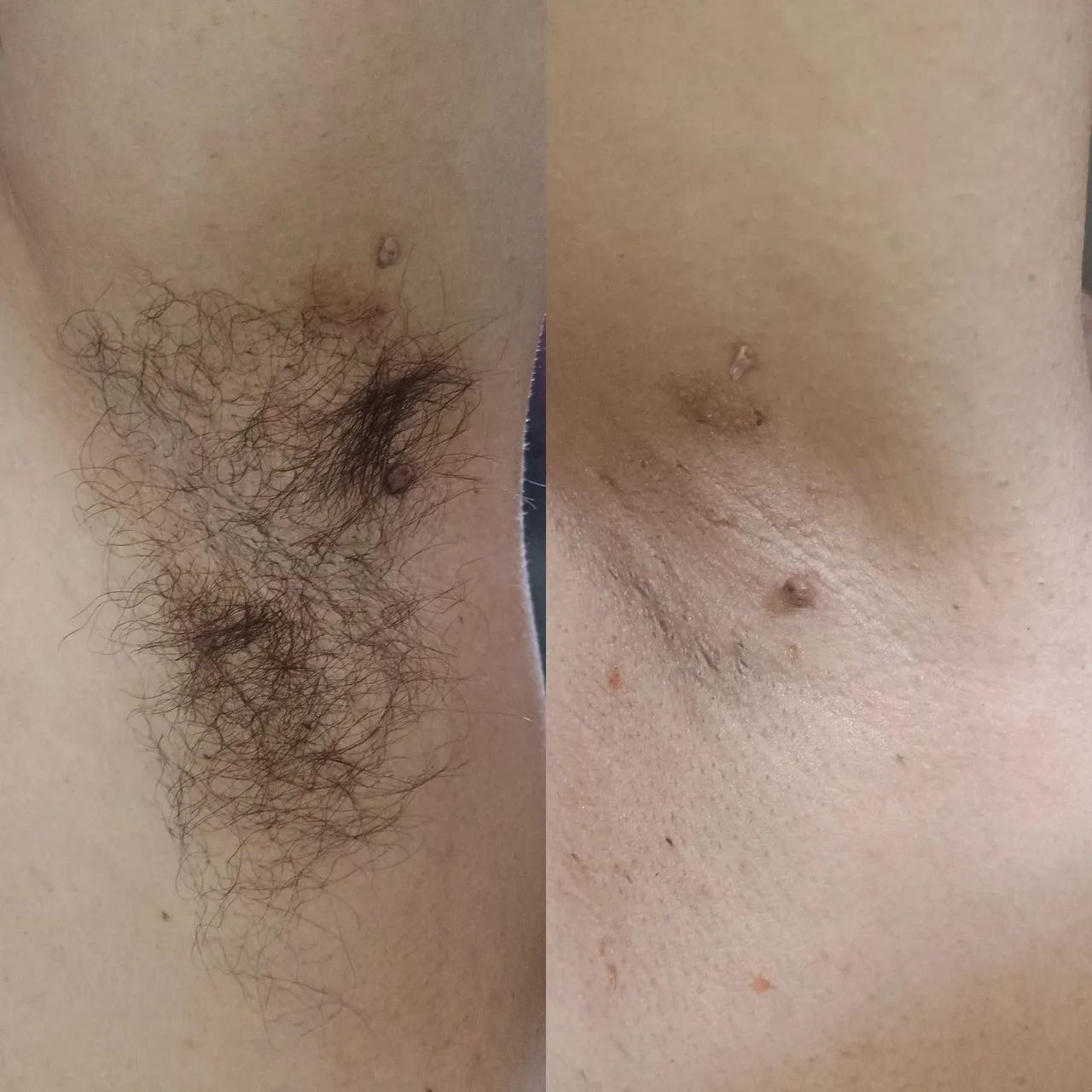 Limpeza de Pele e Depilação a domicílio  - Foto 5