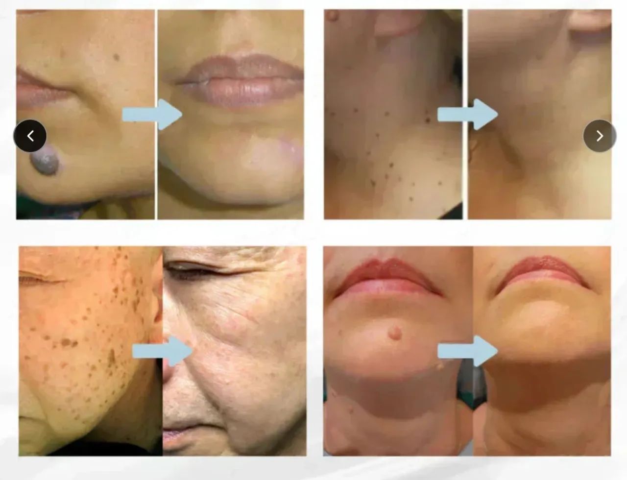 Remoção a laser de pintas e verrugas  - Foto 2