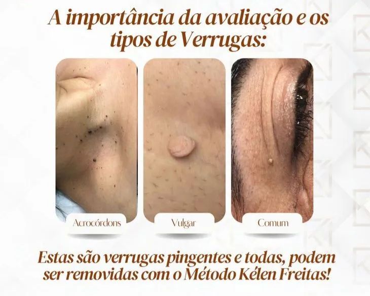Remoção a laser de pintas e verrugas  - Foto 3