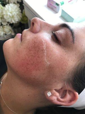 Dermaplaning Facial!! Pele de Seda!