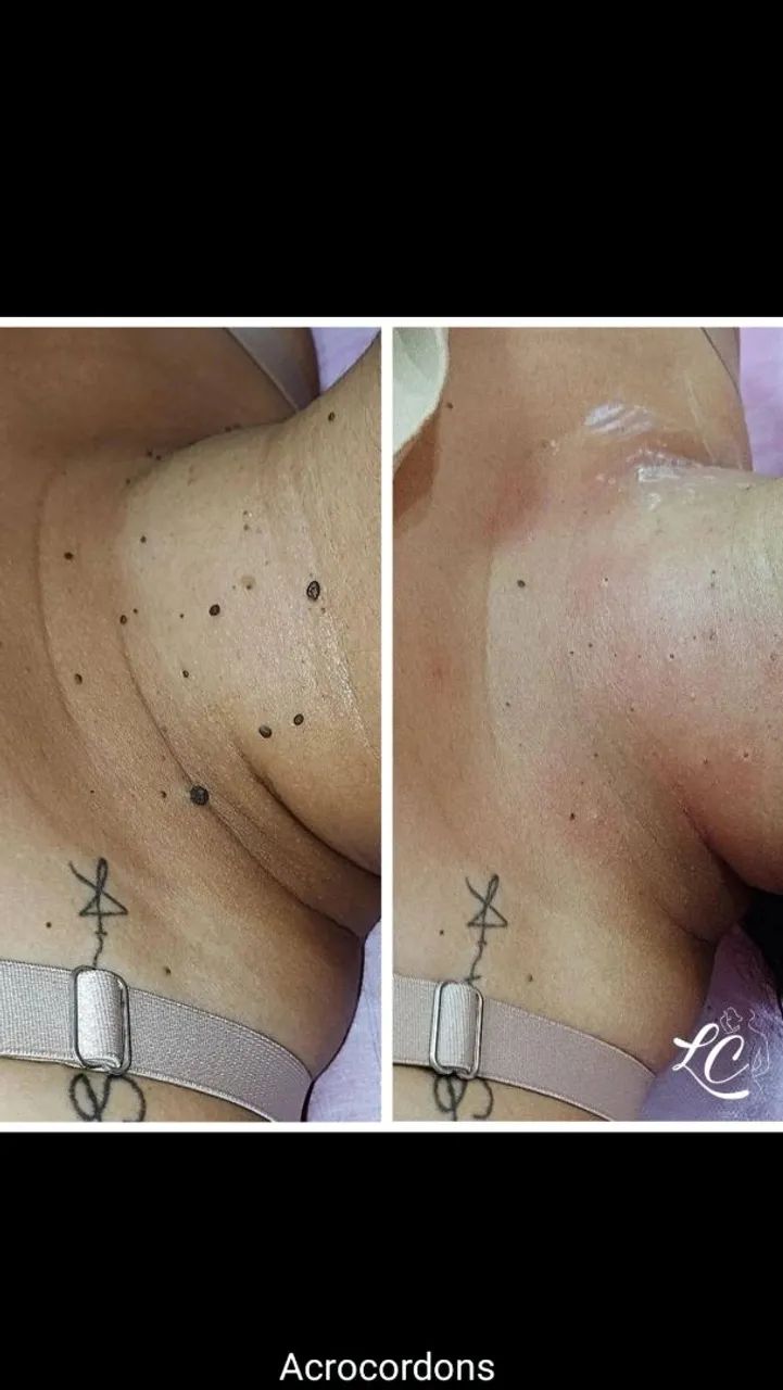 Remoção de sinal  - Foto 2
