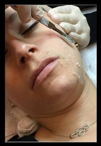 Dermaplaning Facial!! Pele de Seda! - Foto 3
