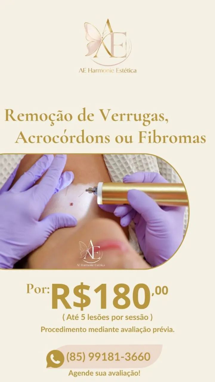 REMOÇÃO DE SINAL