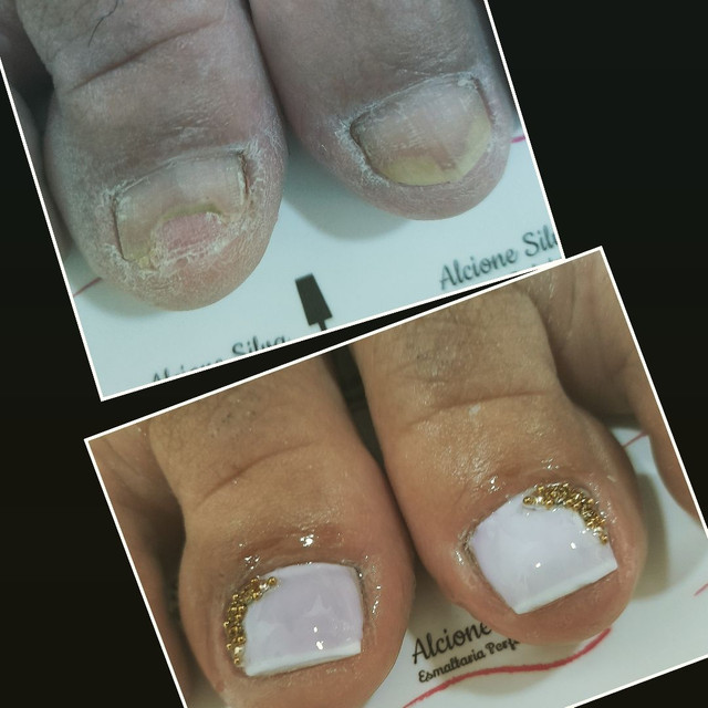 Reconstrução das unhas dos pés 