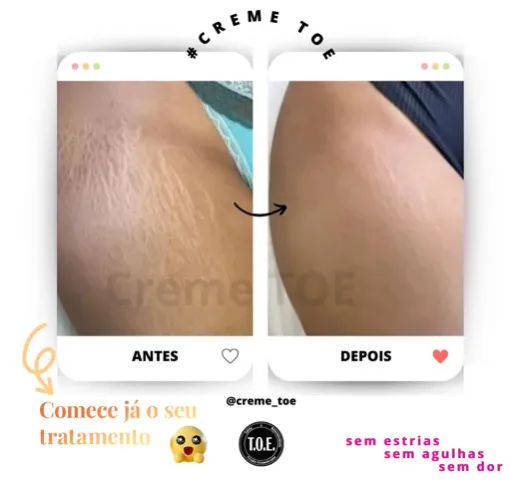 Creme Toe - Tratamento Ortomolecular para Estrias  - Foto 3