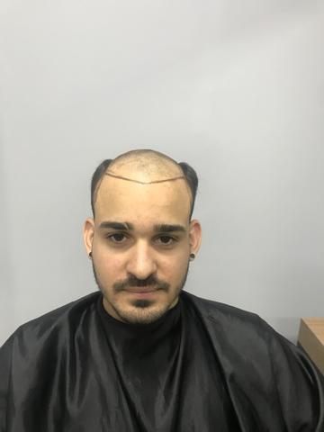 Prótese capilar - Foto 2