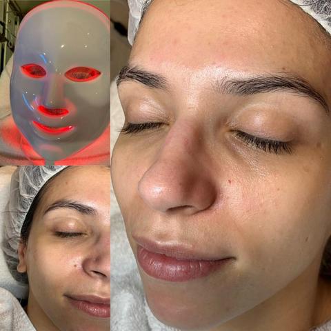 Dermaplaning Facial!! Pele de Seda! - Foto 4