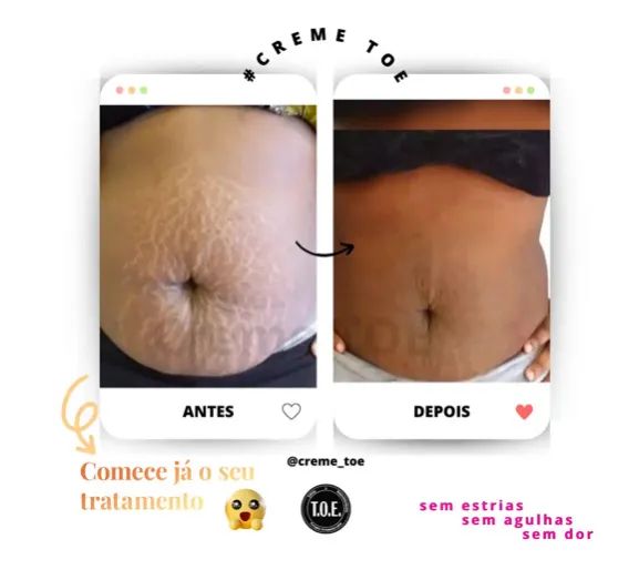 Creme Toe - Tratamento Ortomolecular para Estrias  - Foto 2