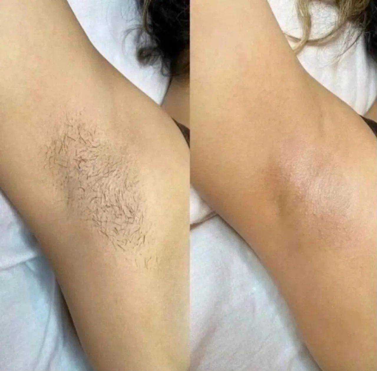 Epilação feminina com cera - Foto 2