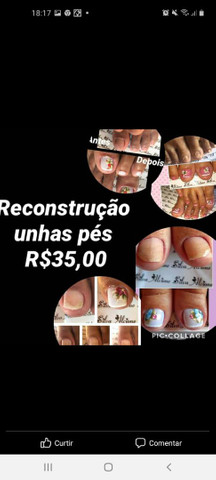 Reconstrução das unhas dos pés  - Foto 4