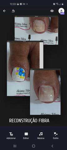 Reconstrução das unhas dos pés  - Foto 2