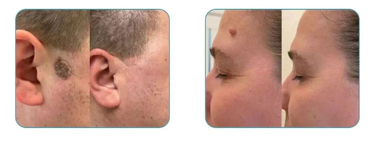 Remoção a laser de pintas e verrugas  - Foto 4