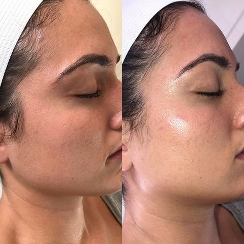 Dermaplaning Facial!! Pele de Seda! - Foto 6