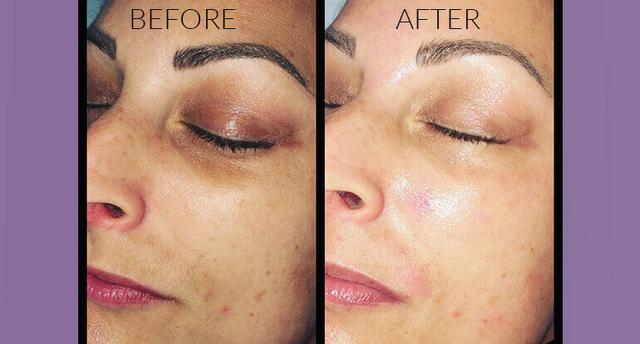 Dermaplaning Facial!! Pele de Seda! - Foto 5