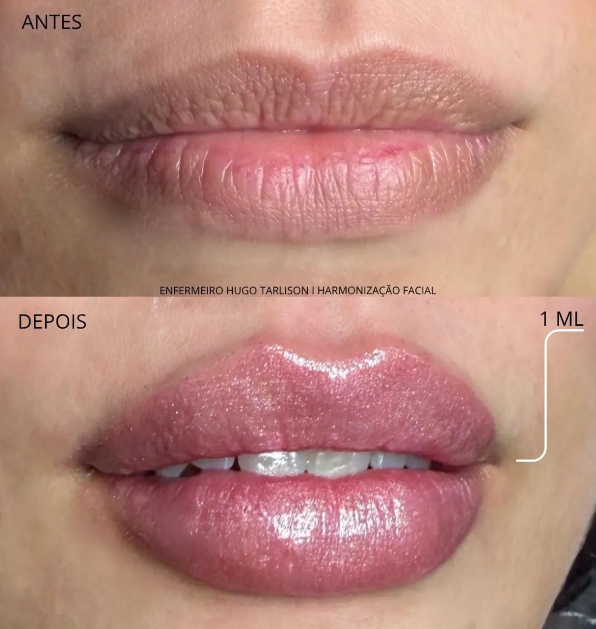 VAGAS PACIENTES MODELOS PARA PREENCHIMENTO LABIAL E BOTOX - Foto 2