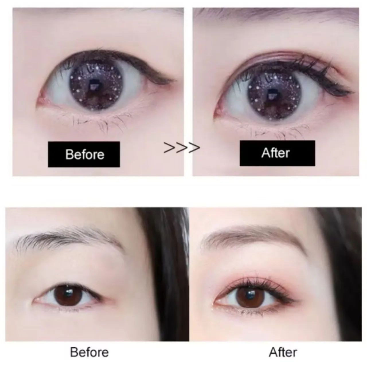 Cola pra Redução de Pálpebras  - Foto 5