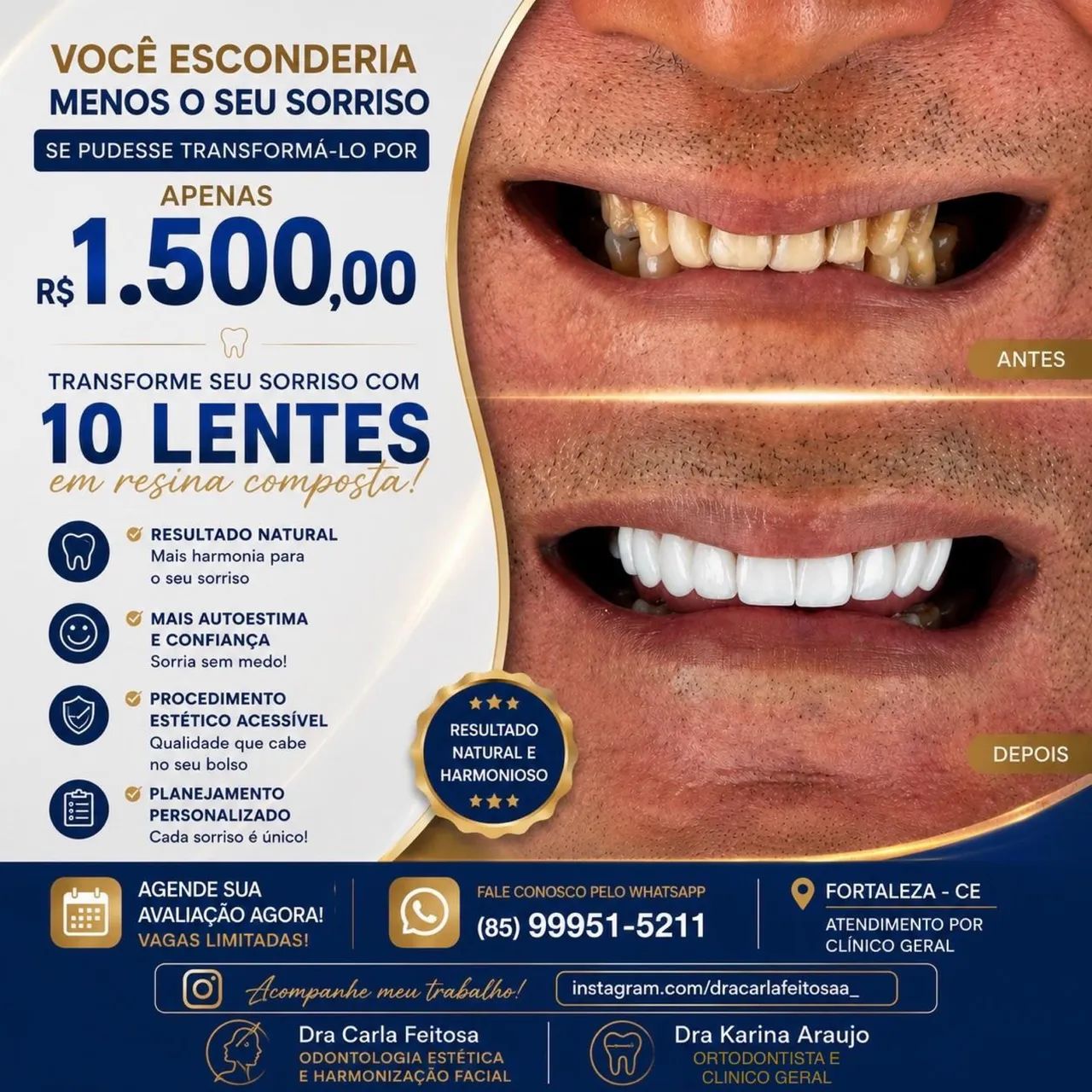 Facetas em RESINA COMPOSTA 
