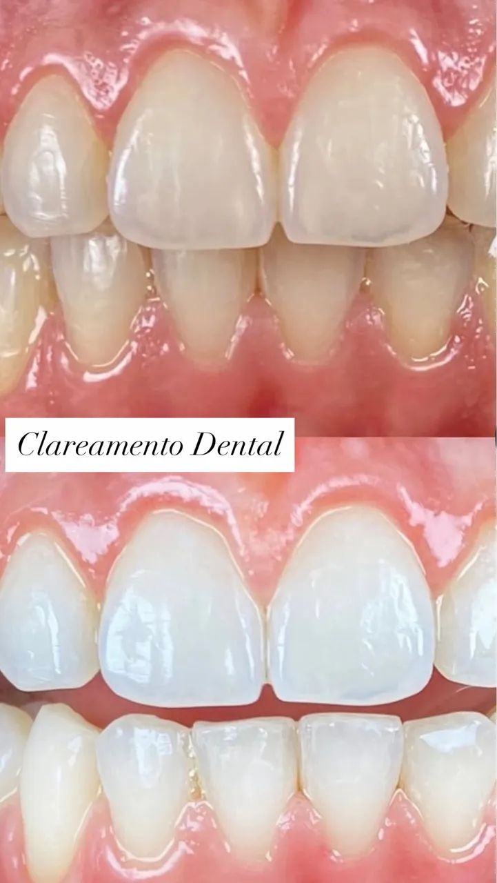 Clareamento dental laser 