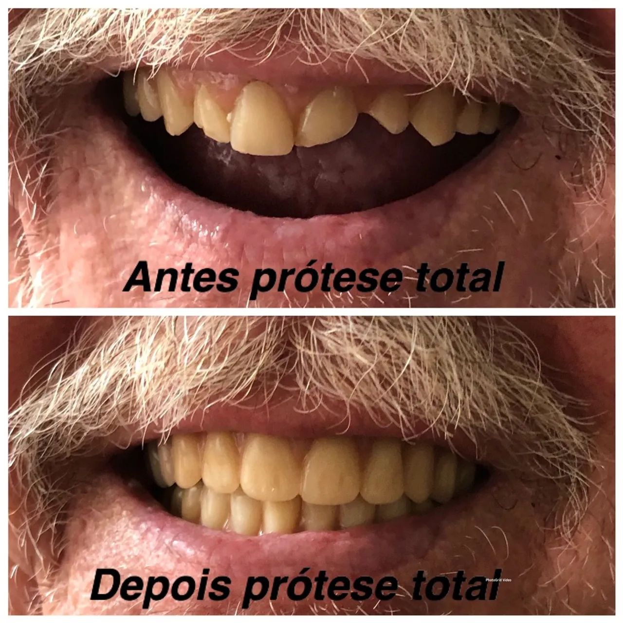 Prótese total a partir de 200 reais  - Foto 5