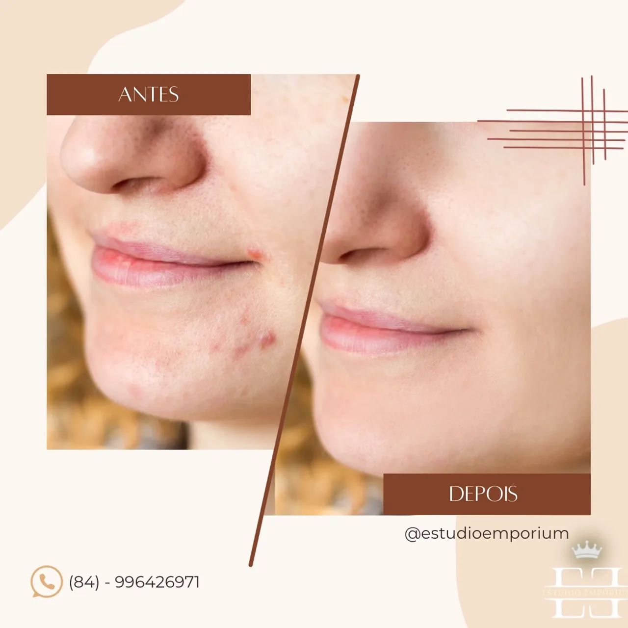 Limpeza de pele profunda  - Foto 3