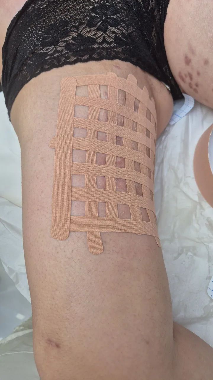 Pós-operatório de Cirurgia Plástica - Foto 2