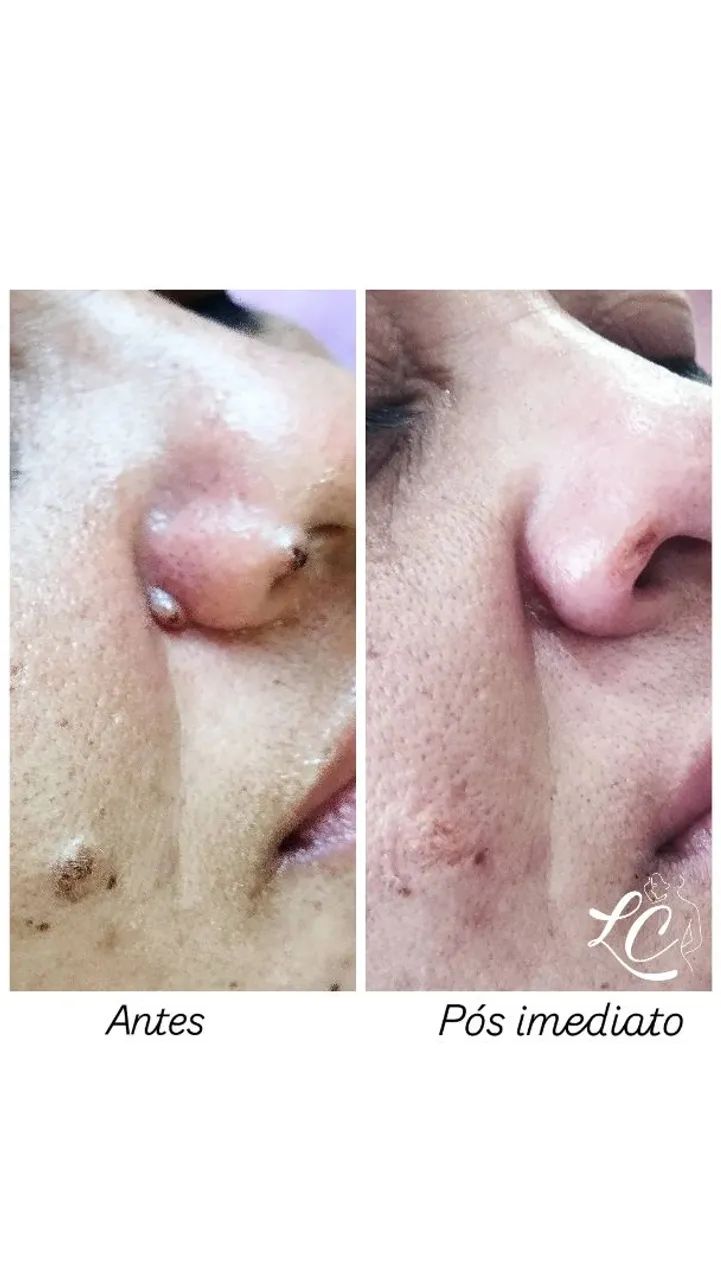 Remoção de sinal  - Foto 4