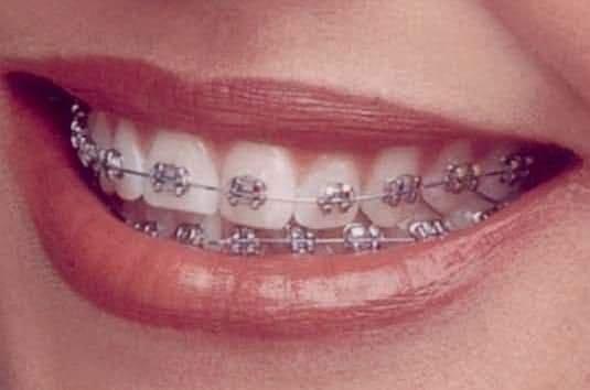 Planos Odontoserv e Odontoprev