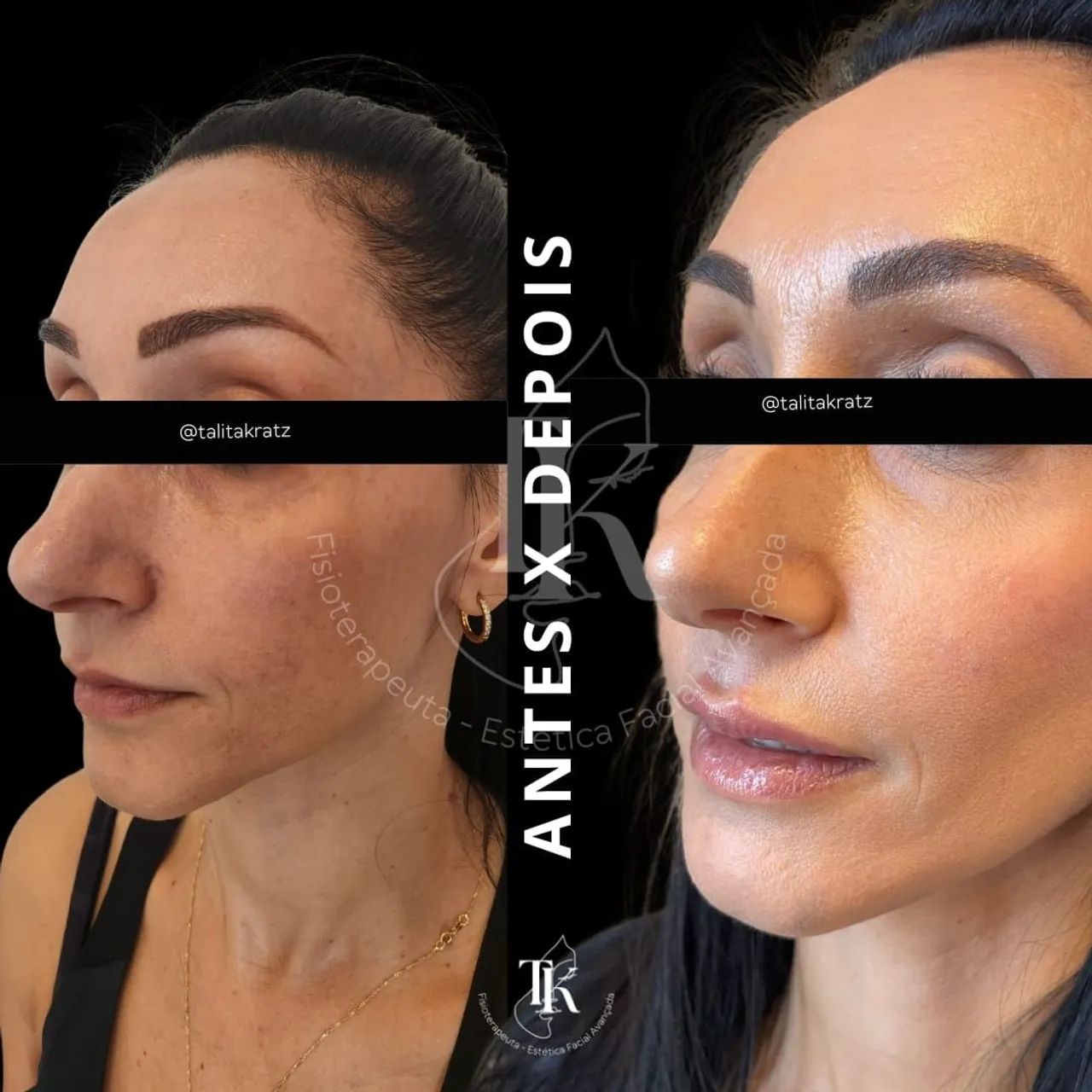 Harmonização Orofacial com Segurança e Naturalidade - Foto 4