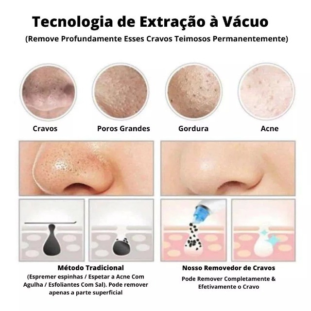 Aparelho Removedor Cravos e Espinhas 4 Em 1 Extrator Vácuo Pele Limpa - Novo - Foto 4