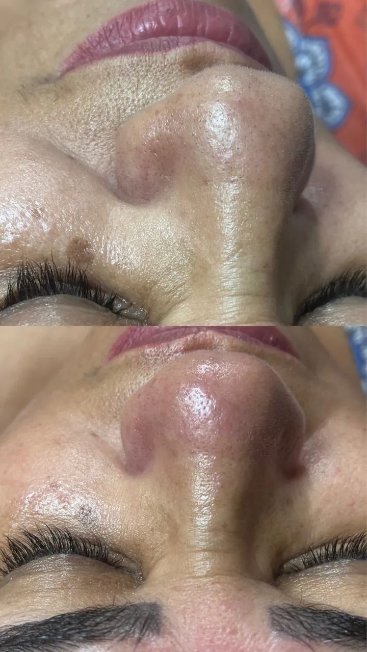 Limpeza de pele profunda completa  - Foto 3