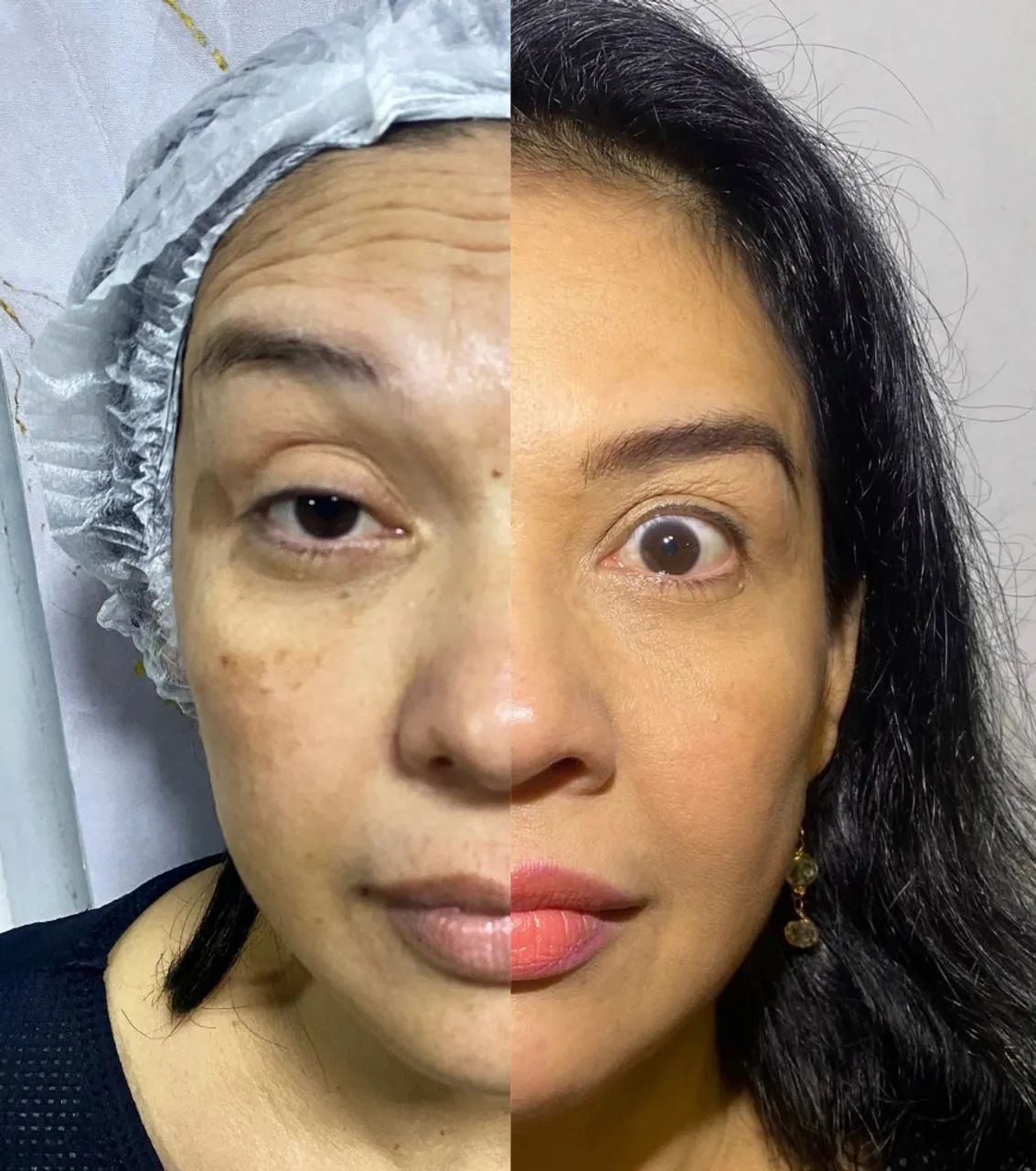 VAGAS PACIENTES MODELOS PARA PREENCHIMENTO LABIAL E BOTOX - Foto 3