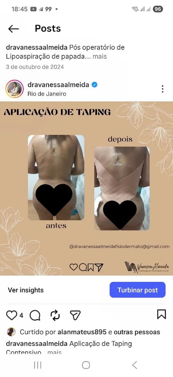 Pós-operatório de Cirurgia Plástica - Foto 4