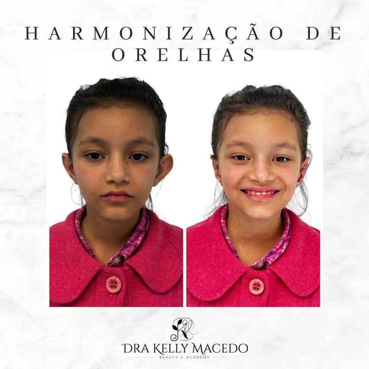 Harmonização de orelhas
