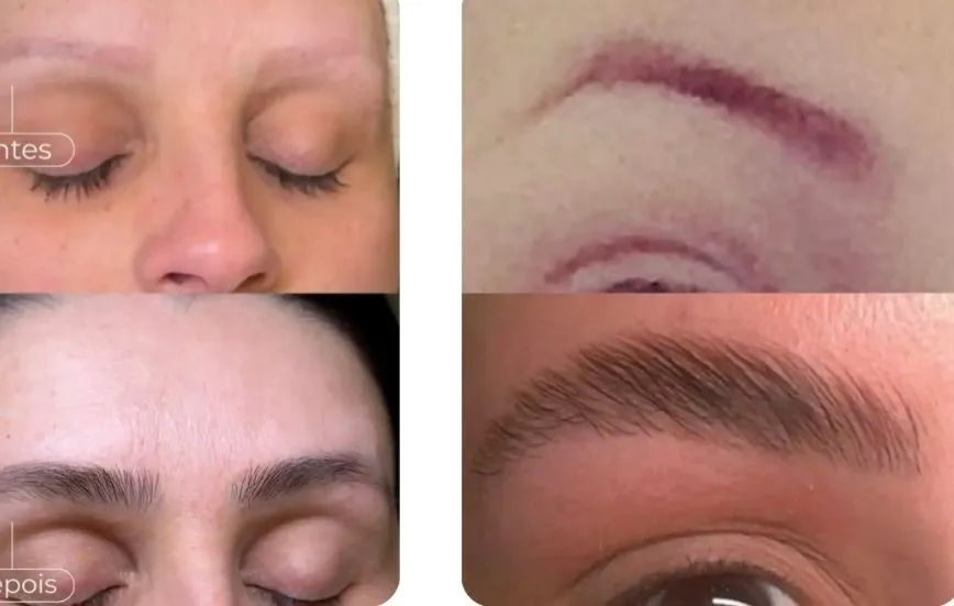 Despigmentação de sobrancelhas  e tratamento com exossomos  de crescimento - Foto 2
