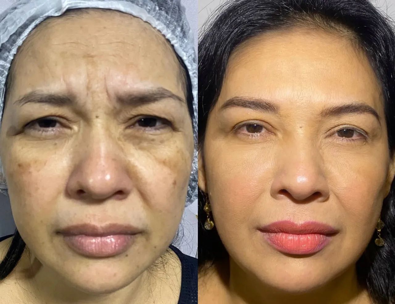 VAGAS PACIENTES MODELOS PARA PREENCHIMENTO LABIAL E BOTOX - Foto 4
