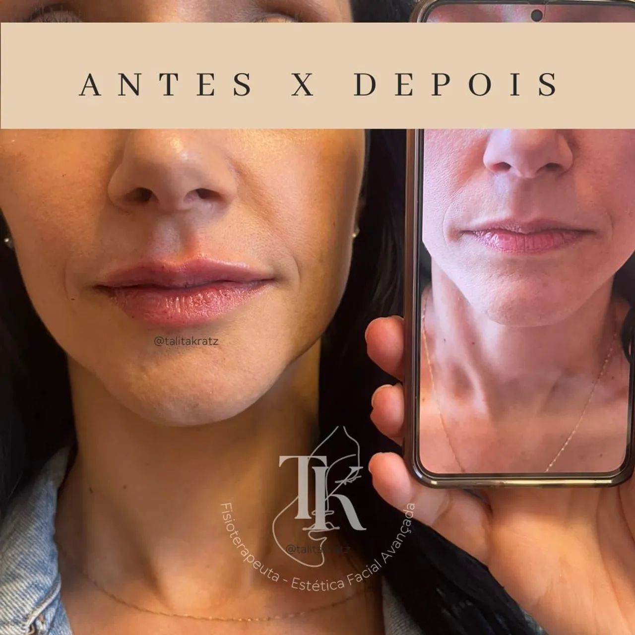 Harmonização Orofacial com Segurança e Naturalidade - Foto 5